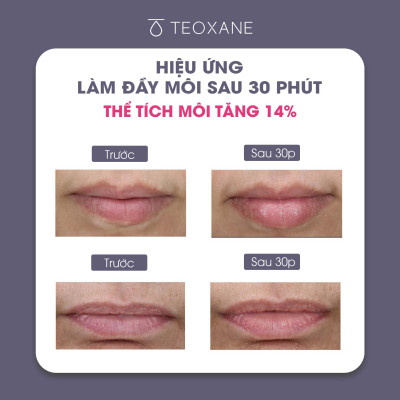 Son dưỡng làm căng đầy môi Teoxane 3D LIP 10ml