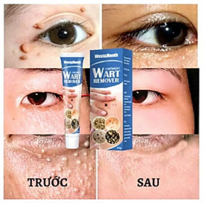 HỘP KEM BÔI TRỊ HẾT MỤN CÓC MỤN THỊT NÚT RUỒI DA THÂM SẠM 