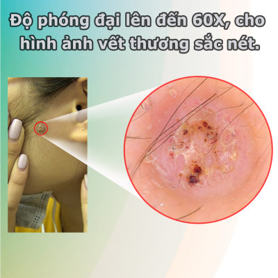 Dermoscopy - Thiết bị soi da tích hợp điện thoại và máy tính bảng MoleScope II